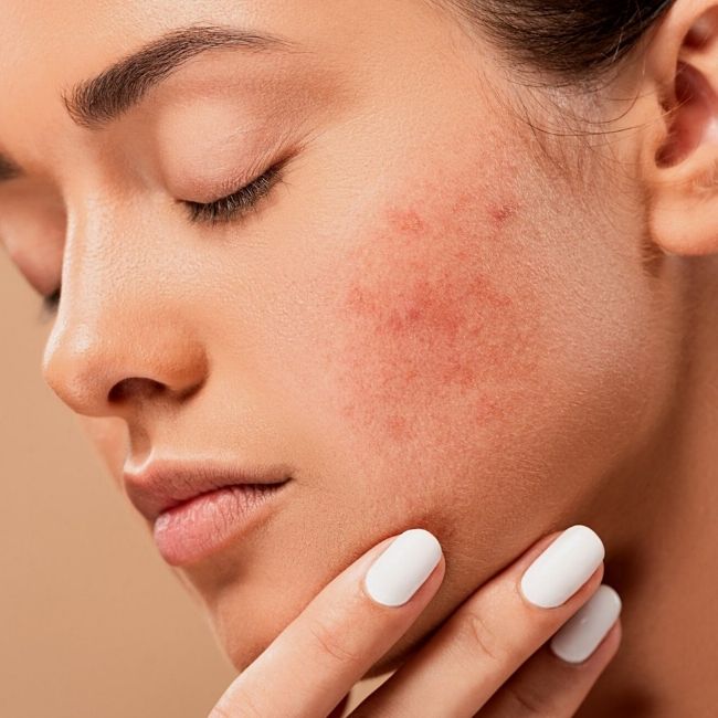 The Ordinary Products for Acne