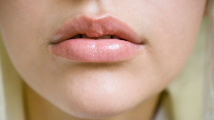 How To Reduce Swelling And Bruising After Lip Fillers – These Work!
