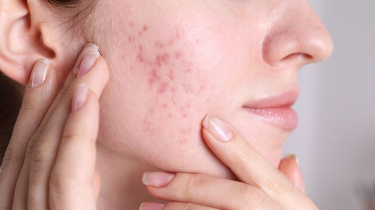 Skincare Routine For Hormonal Acne: A Guide To Clearer, Happier Skin