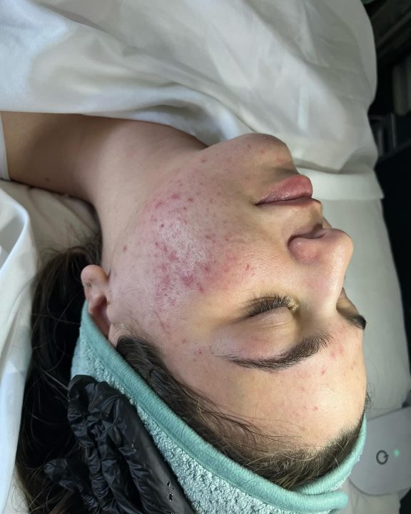 Skincare Routine For Hormonal Acne: A Guide To Clearer, Happier Skin