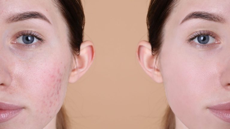 Sensitive Skin? Here’s A La Roche Posay Skincare Guide