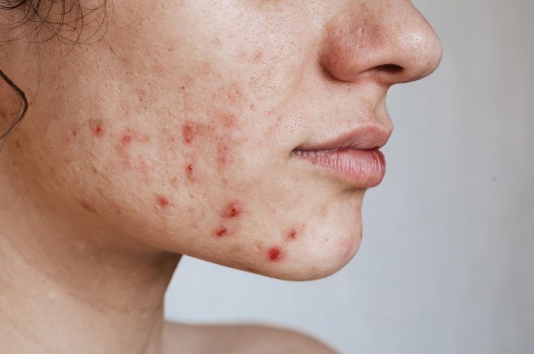 Skin Breakouts While Traveling: A Complete Prevention Guide